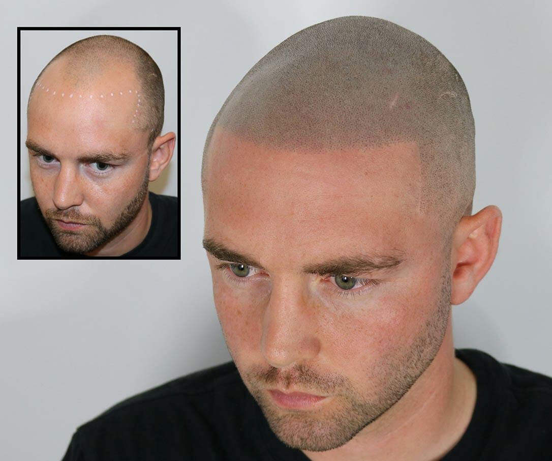 Scalp Micropigmentation in new york