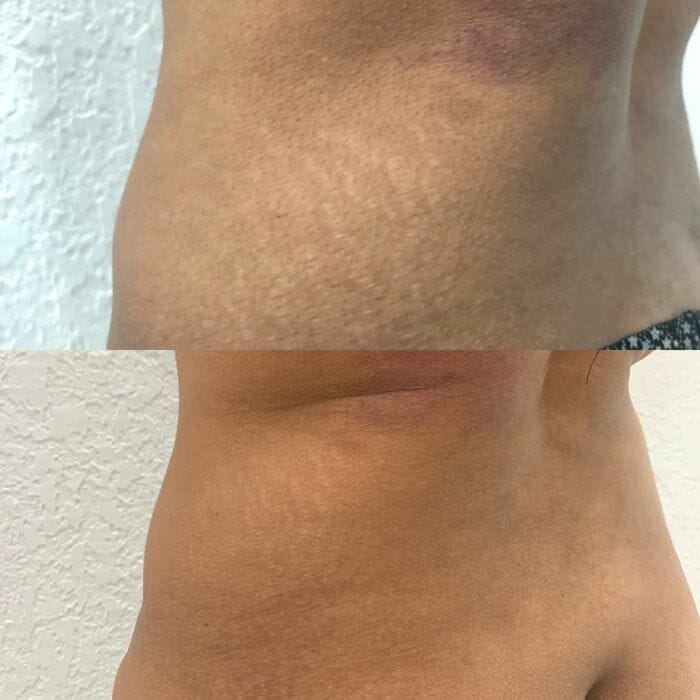 Stretch Mark Cover-Up in NY