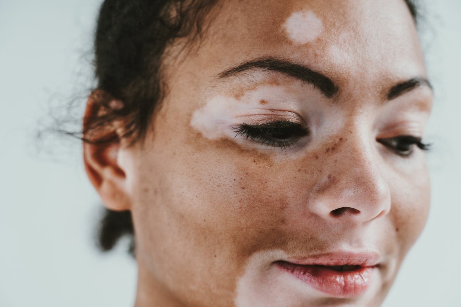 Vitiligo Camouflaging in NY