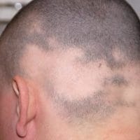 Alopecia Camouflaging